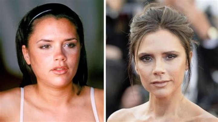 Victoria Beckham's Facelift: Unveiling the Transformation